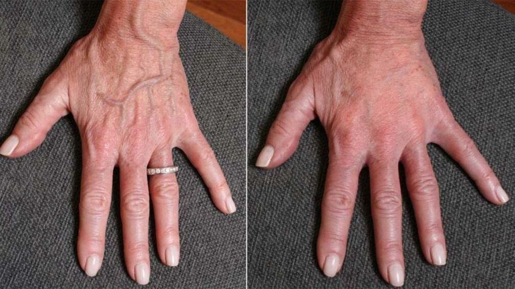 contour plastic, photo refresher hand 1 before and after