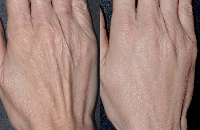 contour plastic, photo refresher hand 2 before and after