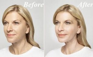 Before and after use of wolfberry cream