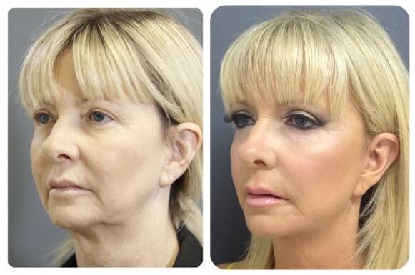 before and after skin rejuvenation with a tighter photo 2