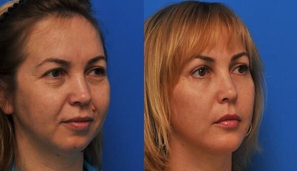before and after skin rejuvenation with photo 1 tighten