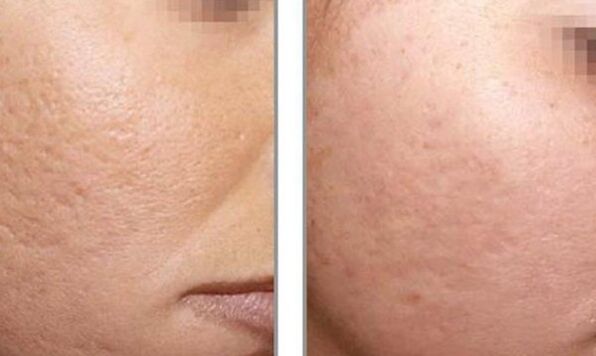 photo before and after laser refresh