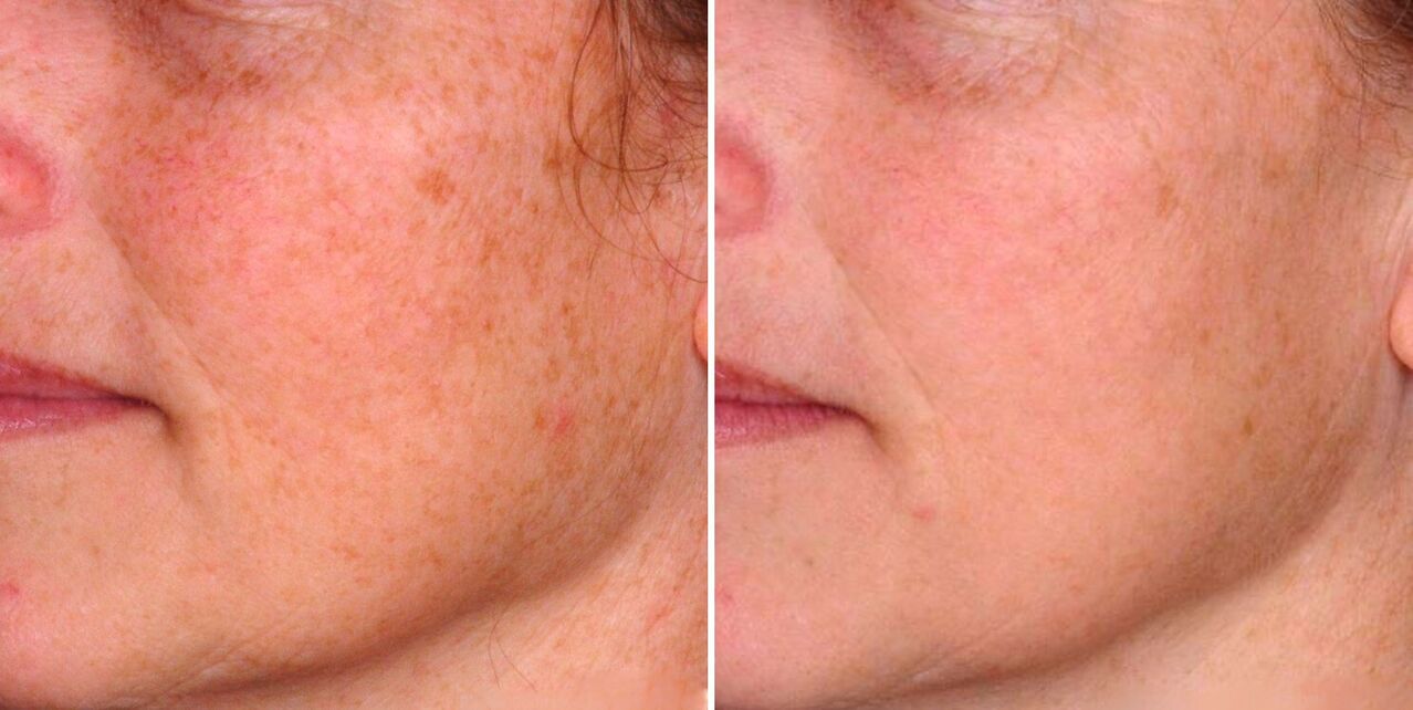 Fractional photothermolysis results in a reduction in age spots on human skin. 